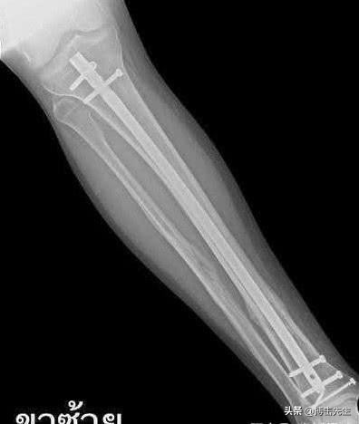 nba骨折钛合金 泰拳手胫骨植入了钛合金板遭到永久禁赛(4)